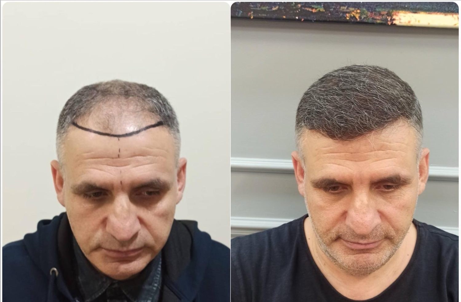 Трансплантация волос до и после — уплотнение фронтальной зоны